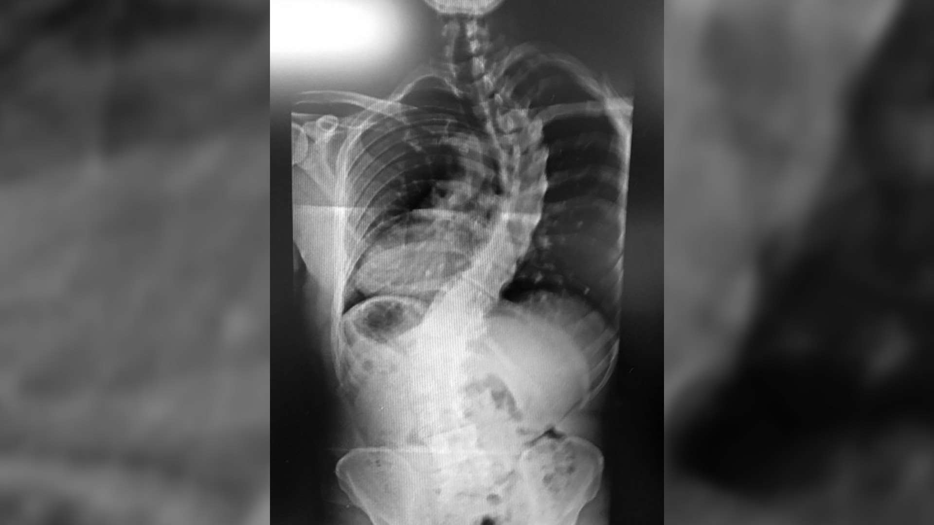 scoliosis x-ray