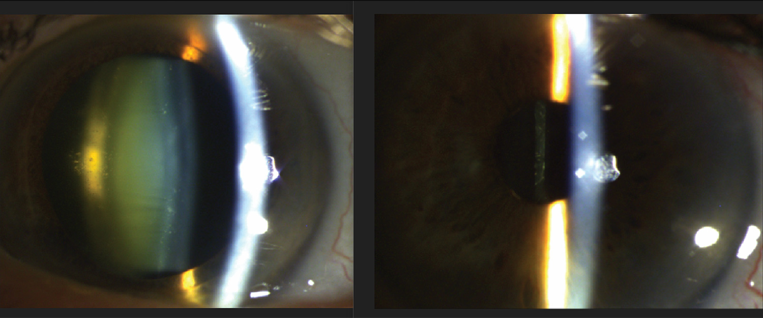 Human eye with cataracts before and after surgery