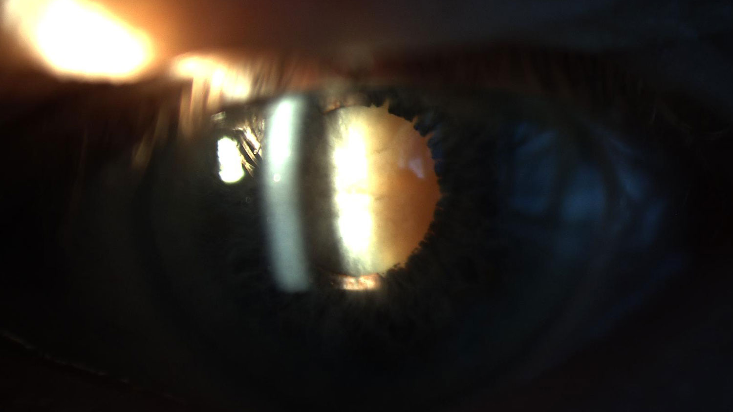 Mature cataract